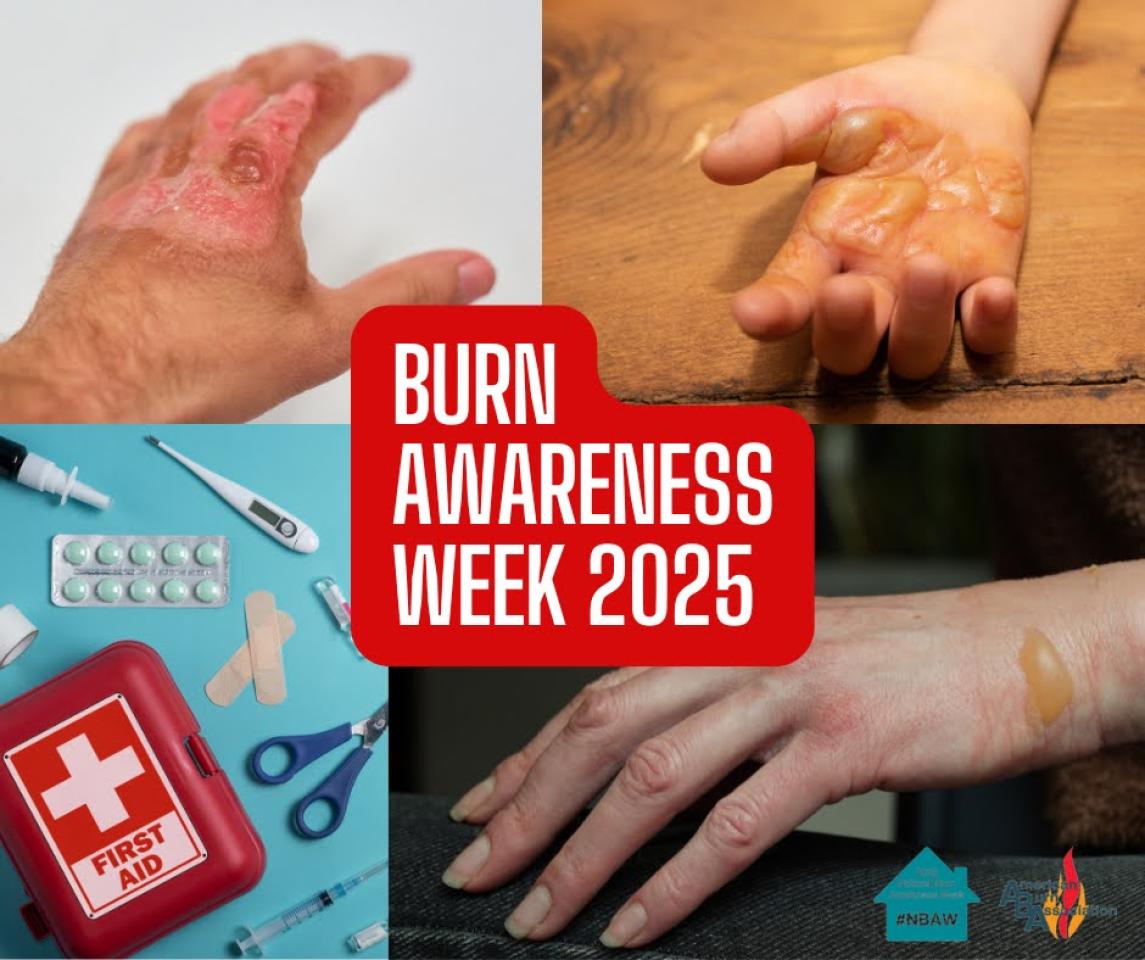 Burn Awareness Week 2025: Preventing Burns in Your Home